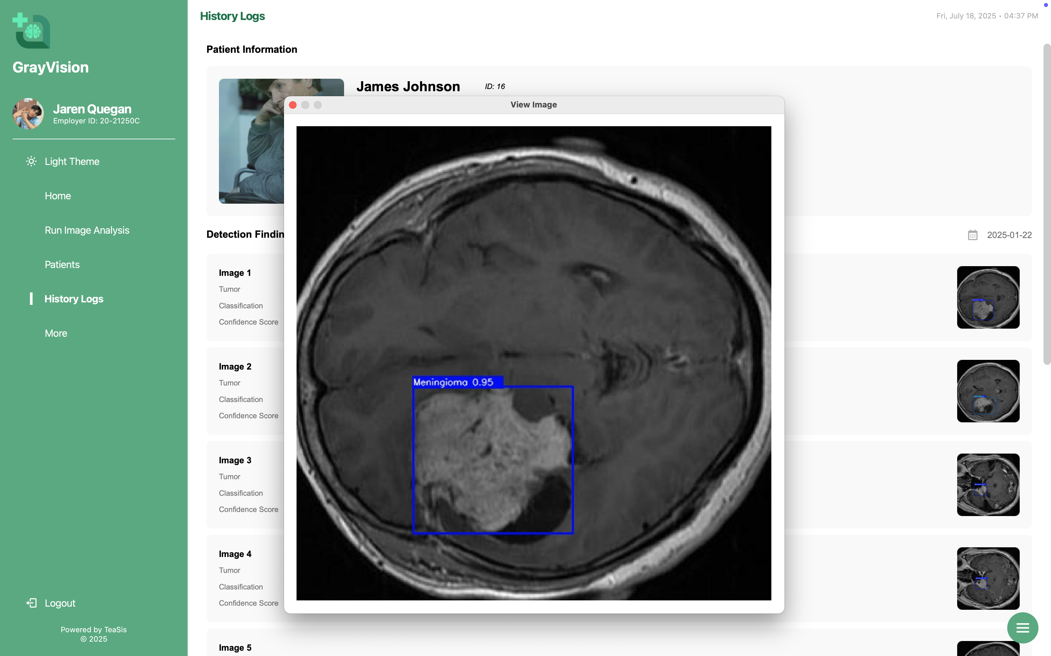 GrayVision – AI-powered Brain Tumor Detection System